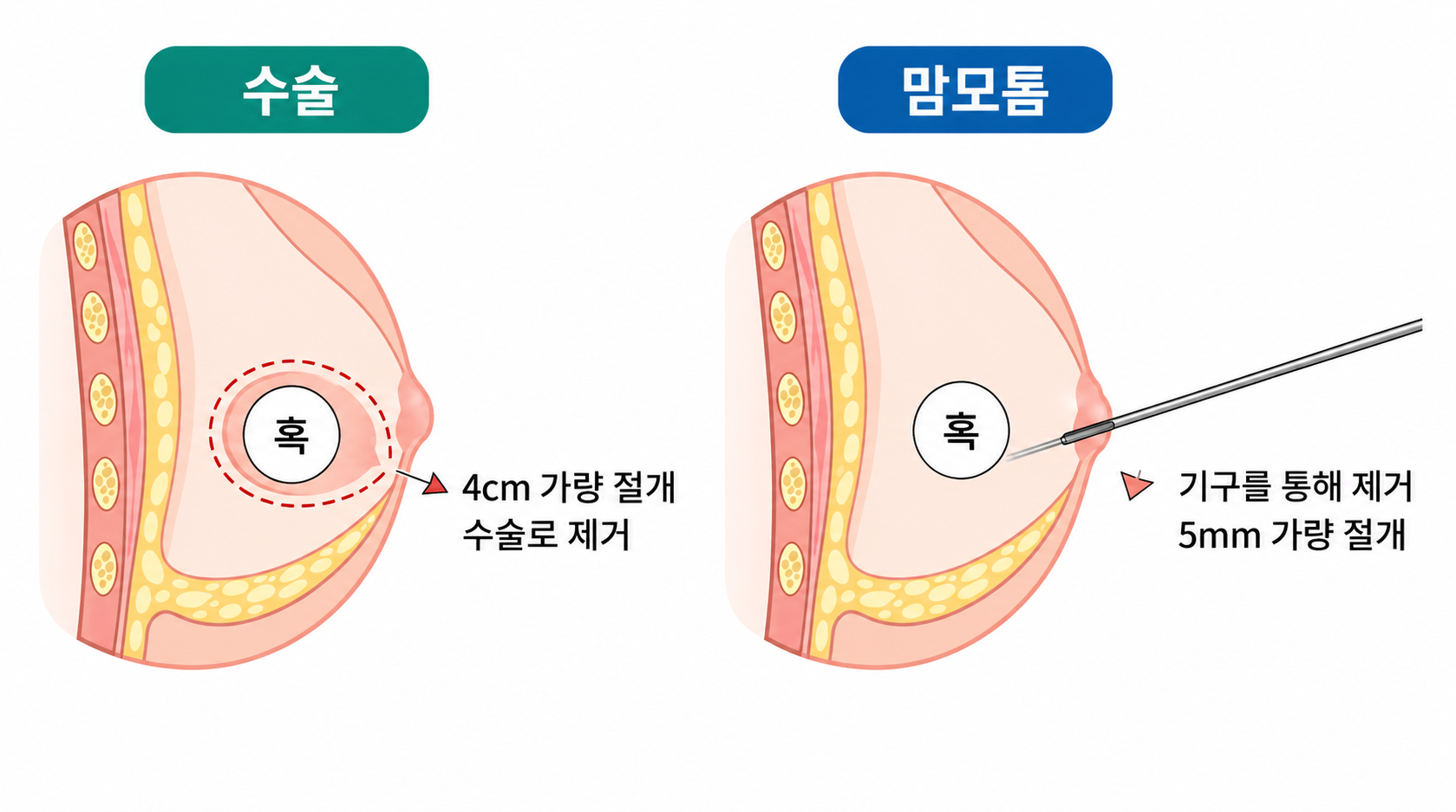 맘모톰 이미지