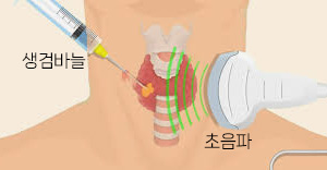 갑상선 조직검사 이미지